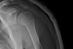 Frattura Omero Prossimale