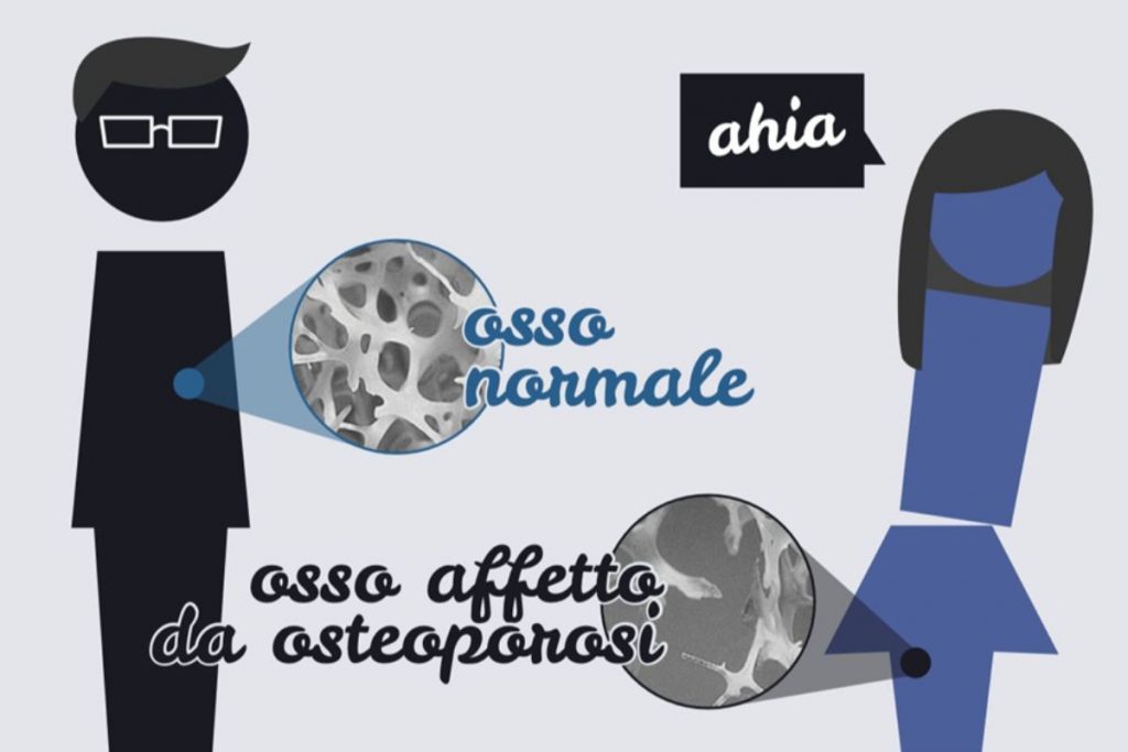 Osteoporosi Ossa Sane